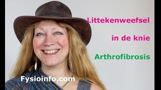 Arthrofibrosis littekenweefsel in het kniegewricht ernstige pijn en stijfheid [upl. by Rosalba]