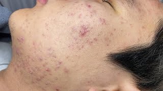 ACNE TREATMENT VU QUYNH MI  Blackheads On Boy Face 2024FULL [upl. by Ailliw]