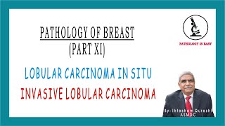 Lobular Carcinoma In Situ and Invasive Lobular Carcinoma by Dr Ihtesham Qureshi [upl. by Karp]