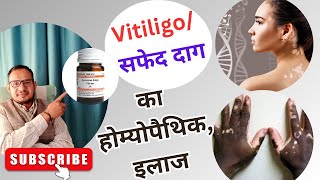 Vitiligo treatment त्वचा पर सफेद दाग का इलाज  white patches  Leucoderma treatment skin sfed dag [upl. by Anairam]