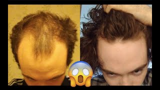 ANTES E DEPOIS  MINOXIDIL  FINASTERID4  15 MESES  CABELO [upl. by De Witt117]