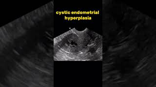 Cystic endometrial hyperplasia ultrasound radiologysonology [upl. by Adabel]