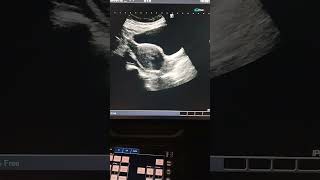 Dermoid cyst in Right ovary by Medical Radiology [upl. by Ingraham]