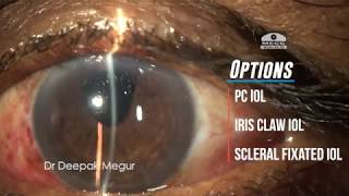 Secondary IOL implantation in an aphakic eye with PC tear amp vitreous prolapse Dr Deepak Megur [upl. by Adnahsat]