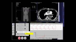 CT Aortic Angiography Aorta dissection [upl. by Tews]