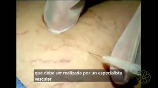 Escleroterapia Tratamiento efectivo para las varices y venas arañitas [upl. by Nosretep940]