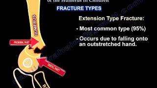 Supracondylar Fractures Of The Humerus In Children [upl. by Cornelius]