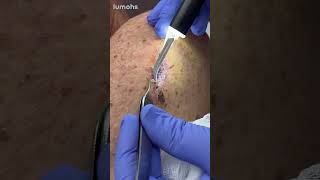 Challenging Suture Removals in Broken Down Dehisced Skin Wounds with Lumohs [upl. by Kcirad]