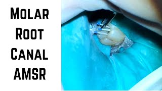 Molar Root Canal AMSR part 1 [upl. by Atikaj]