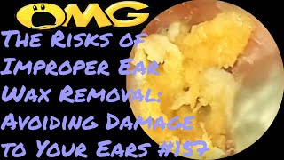 The Risks of Improper Ear Wax Removal Avoiding Damage to Your Ears​ 157 [upl. by Barton]