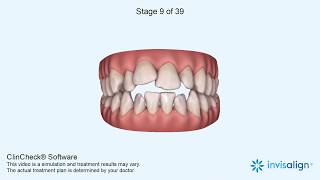 Invisalign Clincheck [upl. by Jacobsen]