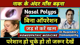 नाक के अंदर माँस बढ़ना। Nasal Polyps Treatment Without Surgery। Nasal Polyps Homeopathic Medicine। [upl. by Ttam]