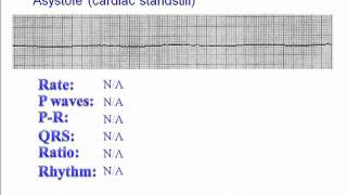 ECG Asystole [upl. by Trueblood]