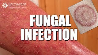 Suffering from Fungal Infection Ringworms WATCH THIS [upl. by Reinold68]