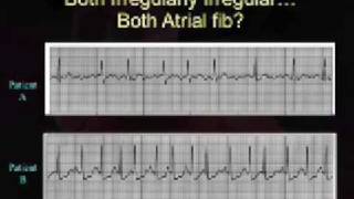 Intro EKG Interpretation Part 3 [upl. by Onitram]