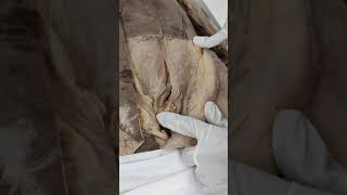 Dissection of Inguinal canal [upl. by Josie]