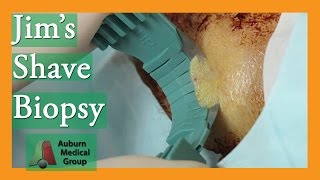 Jims Forehead Shave Biopsy for Basal Cell Carcinoma  Auburn Medical Group [upl. by Sigismond]