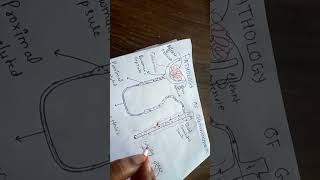 pathogenesis of glomerulonephritis [upl. by Anihsat]