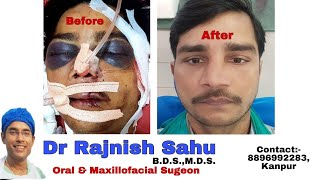 Plastic Surgery Face Before  After Face Surgery  Face Reconstruction  rajnishsahu82 [upl. by Melc]