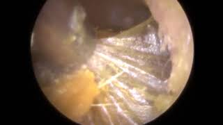 PERFORATED EARDRUM revealed after Endoscopic Ear Wax Removal  325 [upl. by Annoel]