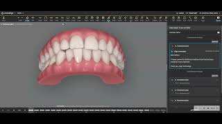 Interproximal Reduction with Invisalign is SAFE if planned properly [upl. by Nosak]