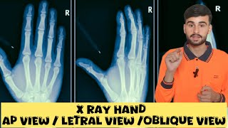 X Ray Hand  ap view  letral view amp oblique view [upl. by Nylrebma401]