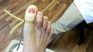 Permanent toenail removal in less than 4 minutes [upl. by Emmaline]