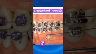 Impacted tooth during Braces [upl. by Fellows]