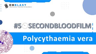 50SecondBloodFilm Polycythaemia vera [upl. by Danell783]