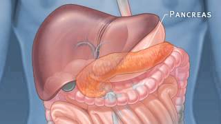 Pancreatic Auto Islet Transplantation with Total Pancreatectomy [upl. by Ainattirb]