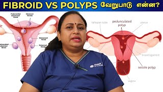 Fibroids and Polyps வேறுபாடுகள் என்ன  Differences between Fibroids and Polyps  Dr G Buvaneswari [upl. by Ahteres]