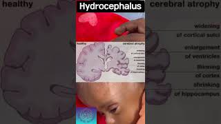 hydrocephalus  water in brain  awareness [upl. by Richards]