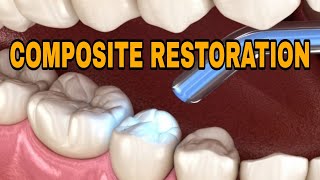 Composite Restoration For Dental Students🦷 [upl. by Madora]