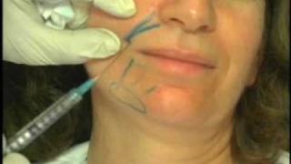 Sculptra Procedure Demonstration by Dr Mest  Part 1 [upl. by Odlaniger943]