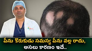 Alopecia areata Symptoms Causes and Treatment  Treatment for Alopecia Areata  Hair Loss treatment [upl. by Swihart853]