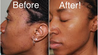 How To Get Rid of Moles and Dark Spots Fast DPNS [upl. by Beka]