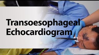 Transoesophageal Echocardiogram [upl. by Hcirdeirf917]