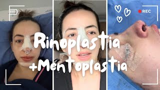 Rinoplastia e mentoplastia [upl. by Neill]