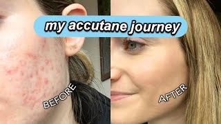 MY ACCUTANE JOURNEY  acne side effects results tips skincare everything you need to know [upl. by Valsimot]