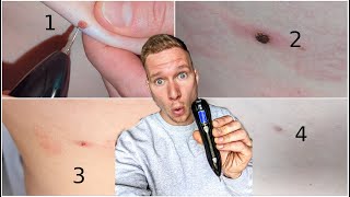 VOONEEN Mole Removal Pen  Leberflecke selbst entfernen 🤔 TEST [upl. by Chin593]