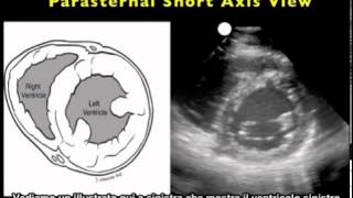 Video procedurale Ecografia cardiaca  Asse corto parasternale [upl. by Alekal]