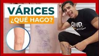 VÁRICES en las PIERNAS ❌ Síntomas y Tratamiento [upl. by Aljan746]