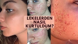 Sivilce LEKELERİMDEN Nasıl Kurtuldum DERMAPEN Kimyasal Peeling [upl. by Jamie]