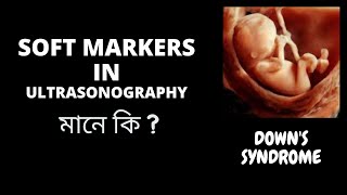 SOFT MARKERS IN ULTRASONOGRAPHY [upl. by Karrie]