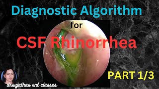 234CSF Rhinorrhea Part 13  Diagnostic Algorithm for Cerebrospinal Fluid Leak surgeryeducation [upl. by Annairoc60]