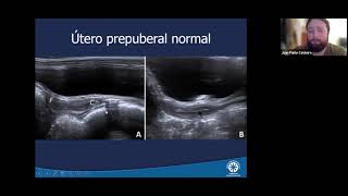 Webinar Pediatría  Ecografía ginecológica pediátrica [upl. by Benisch]