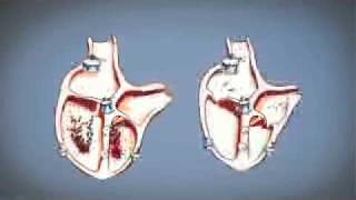 Arrêt cardio respiratoire  défibrillateur  arrêt cardiaque [upl. by Santiago]