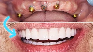 PERMANENT FIXED IMPLANT DENTURE Procedure Steps Before amp After w Zirconia Hybrid All On 4 amp Acrylic [upl. by Ithnan280]