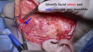 Inset Sutures for Gracilis [upl. by Yentruoc]