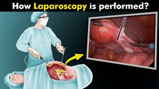 What Happens During Laparoscopy Procedure UrduHindi [upl. by Pride16]